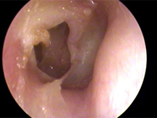 慢性化膿性中耳炎の症例