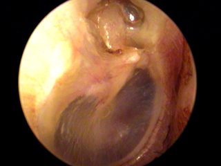 真珠腫性中耳炎の症例