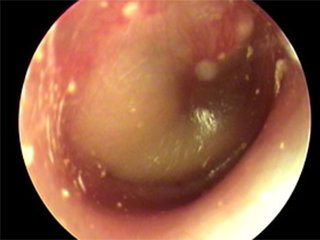 急性中耳炎の一例