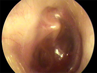 滲出性中耳炎の症例