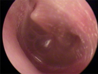 滲出性中耳炎の症例